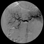 腹部血管造影写真